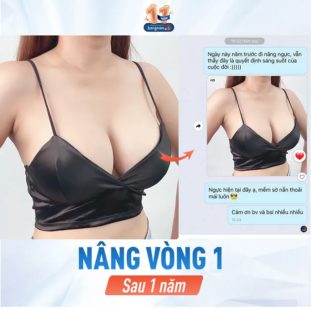 Khách hàng chia sẻ sau 1 năm nâng vòng 1 tại Kangnam