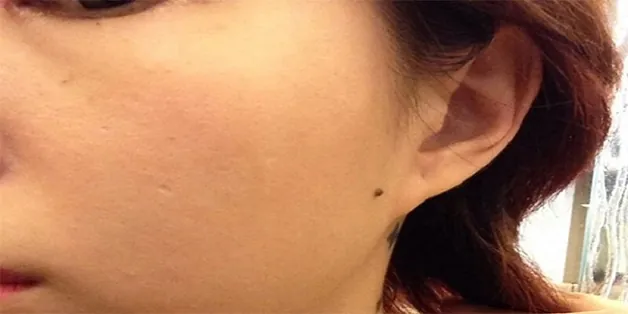 Nốt ruồi trên má gần tai 