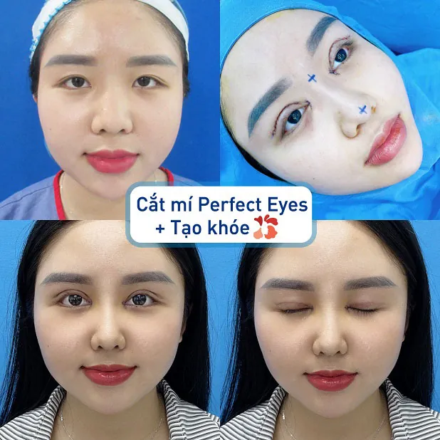 Cắt mí Perfect Eyes kết hợp cùng với việc tạo khóe mắt