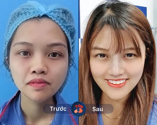 Mũi thấp tẹt đã được khắc phục