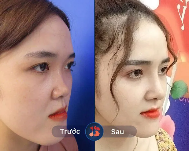 Dáng mũi thay đổi sau khi khách hàng nâng mũi thành công