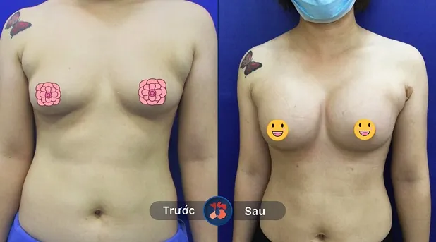 "Nâng cấp" dáng ngực tự nhiên như ý muốn khách hàng