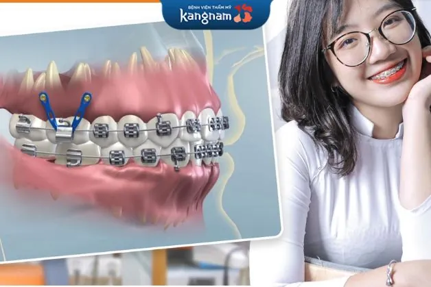 Chú ý chăm sóc cẩn thận sau bắt vis