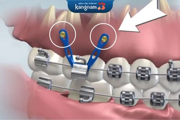 Bắt vít niềng răng có nhiều công dụng tuyệt vời