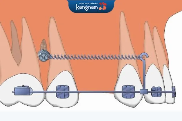 Cần cắm vis cho tới khi kết thúc niềng răng