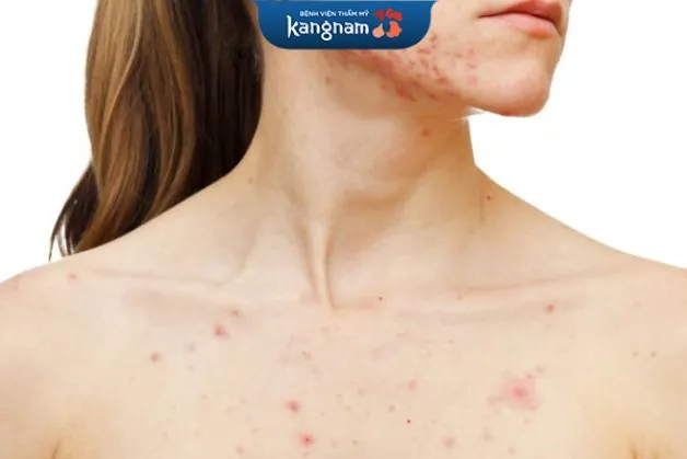 Cơ địa nhạy cảm dễ bị mụn dị ứng