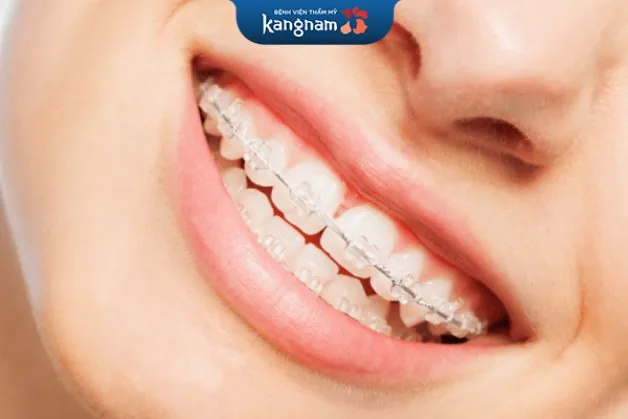 Đảm bảo kết quả niềng tối ưu