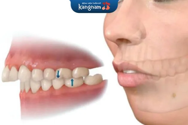 Hàm hô nặng cần phải bắt vis hỗ trợ khi niềng