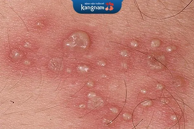 Mụn cóc mọc xung quanh cơ quan sinh dục khiến bệnh nhân có cảm giác ngứa ngáy, khó chịu