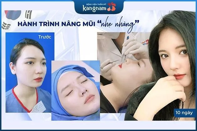 Nâng mũi 6D - Nâng mũi nhẹ nhàng