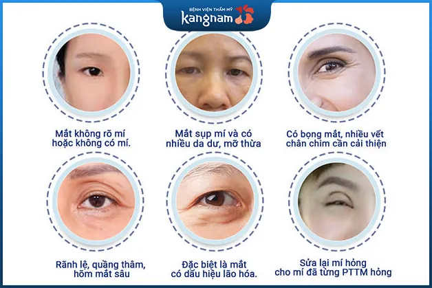 Những người nên thực hiện cắt mí mắt Perfect Eyes