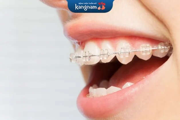 Niềng mắc cài sứ mang tính thẩm mỹ cao