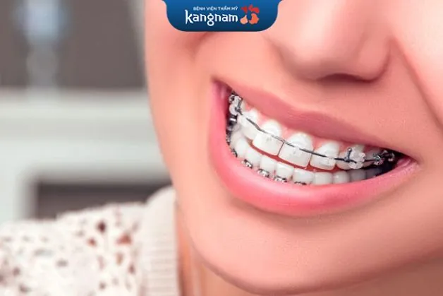 Thanh trượt trong mắc cài thay thế cho chun chỉnh nha hỗ trợ quá trình niềng răng diễn ra xuyên suốt