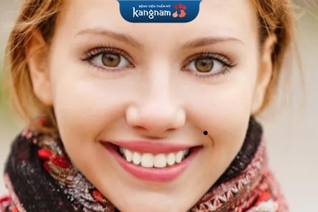 Nốt ruồi đen giữa đường pháp lệnh không tốt cho sức khỏe