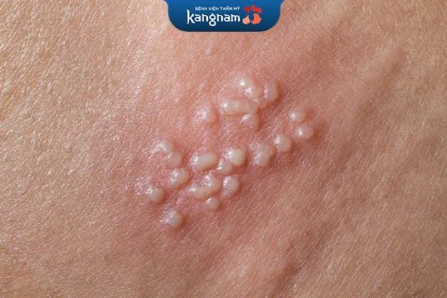 Cách điều trị mụn cóc sinh dục ở nam giới