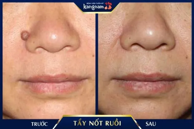 Tẩy mụn ruồi hiệu quả tức thì tại BV Kangnam