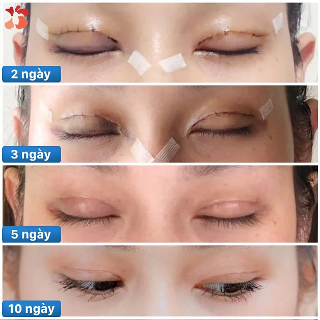 Bổ sung gói chườm mắt, giúp mí mắt hồi phục chỉ sau phẫu thuật 5 ngày