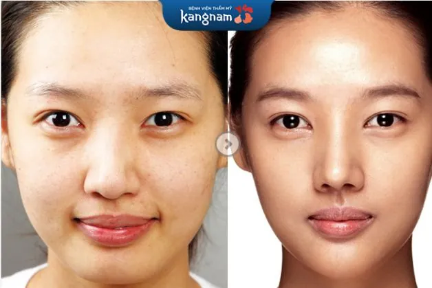 Tạo khối che giấu khuyết điểm sống mũi vẹo