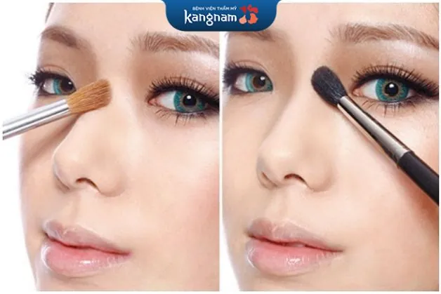 Mũi to bè cũng được hô biến thành sống mũi cao tây