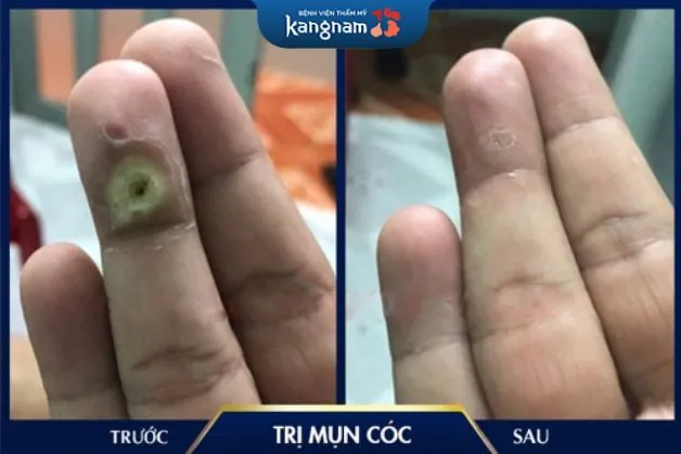 Cách điều trị mụn cóc sinh dục ở nam giới