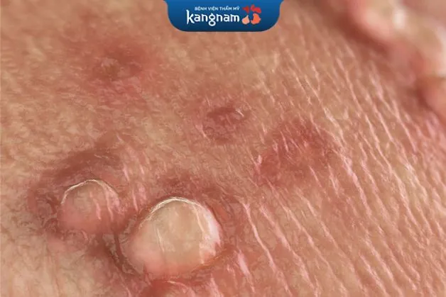 Cách điều trị mụn cóc sinh dục ở nam giới