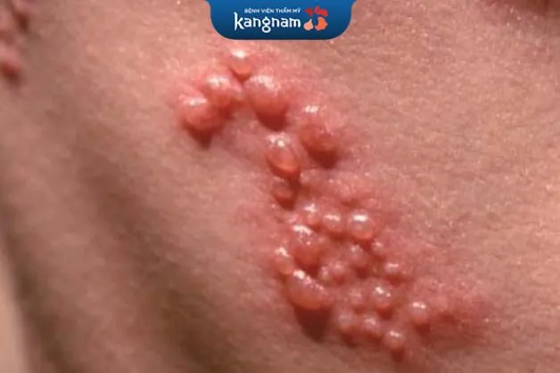 mụn rộp có những biểu hiện ngứa và đau, diễn ra trong 2-7 ngày sau khi