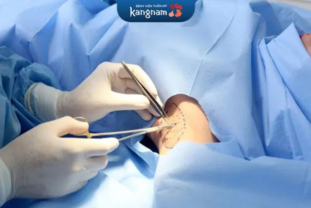 Cắt mồ hôi nách an toàn với chi phí hợp lý tại Kangnam