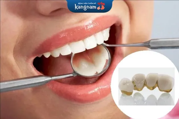 Có nên bọc răng sứ titan không?