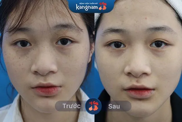 Xóa tàn nhang tại vị trí nhạy cảm nhất mà không ảnh hưởng đến sức khỏe làn da