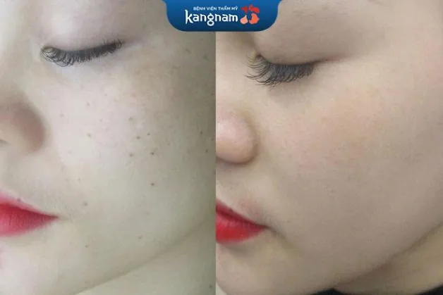 Loại bỏ hoàn toàn tàn nhang và đốm nâu trên da chỉ sau 1 liệu trình