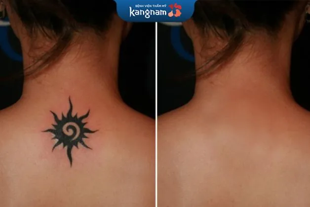 Xóa xăm không để lại sẹo và không làm ảnh hưởng đến sắc tố da