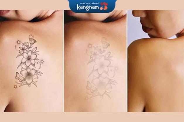 Công nghệ xóa xăm bằng laser sử dụng năng lượng có chọn lọc