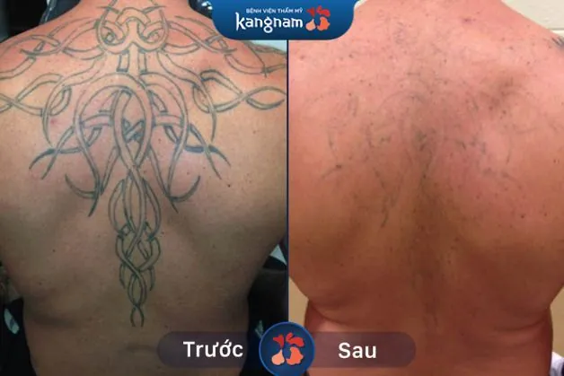 Hình xăm kích thước lớn mờ đến 95%