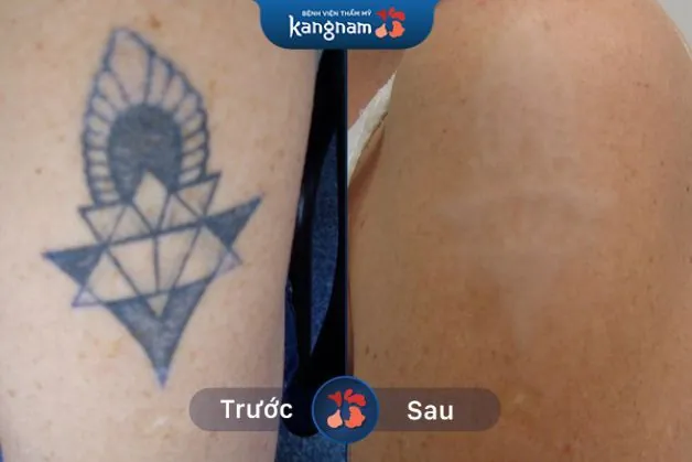 Tia Laser Picosure xóa xăm an toàn