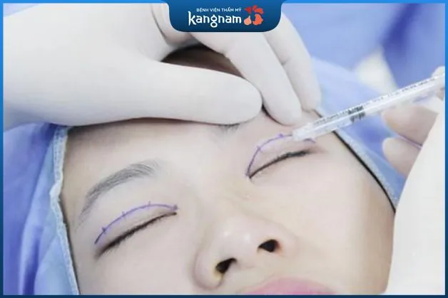 Bao lâu thì được cắt mí sau khi hết ngày đèn đỏ?