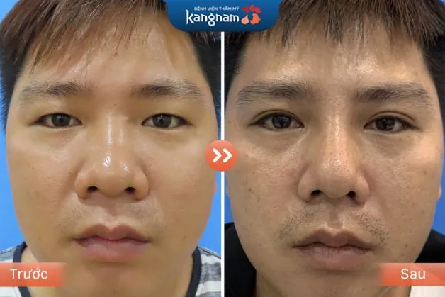 Gương mặt trở nên sắc nét và góc cạnh sau khi cắt mí