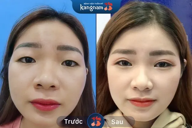 Diện mạo khách hàng trở nên thanh thoát, nhẹ nhàng nhờ đường mí mềm mại