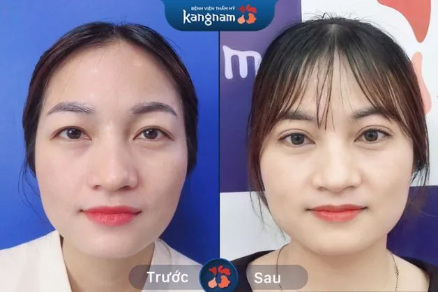 Đường mí cân đối, hài hòa với gương mặt khách hàng