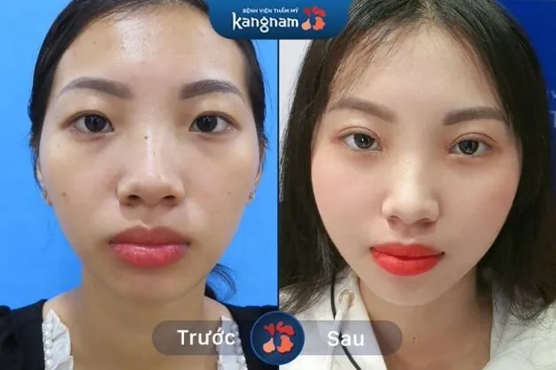 Cắt mí không đau, không sẹo và nhanh lành thương