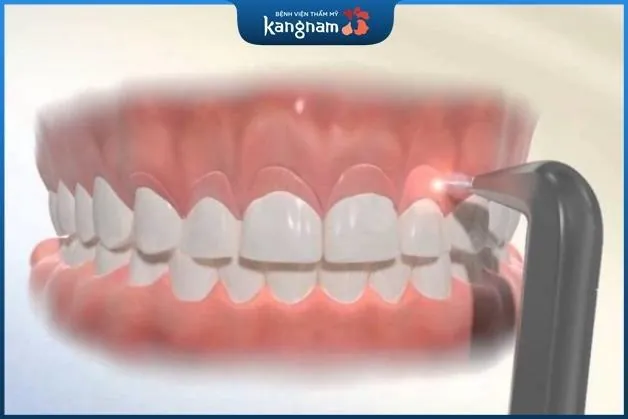 Cắt nướu bằng laser không gây xâm lấn