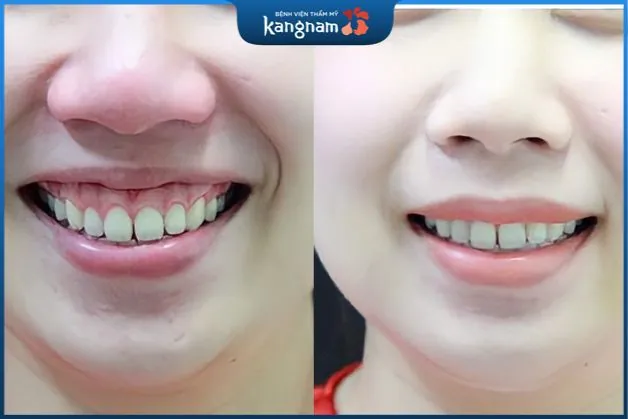 Tự tin với nụ cười xinh sau phẫu thuật chữa cười hở lợi