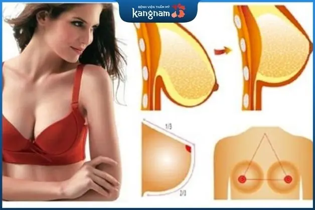 Công nghệ treo ngực sa trễ hiện đại, ít xâm lấn