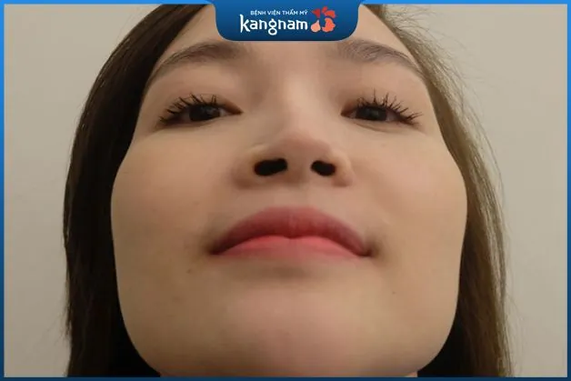 Dấu hiệu nhận biết vách ngăn mũi lệch