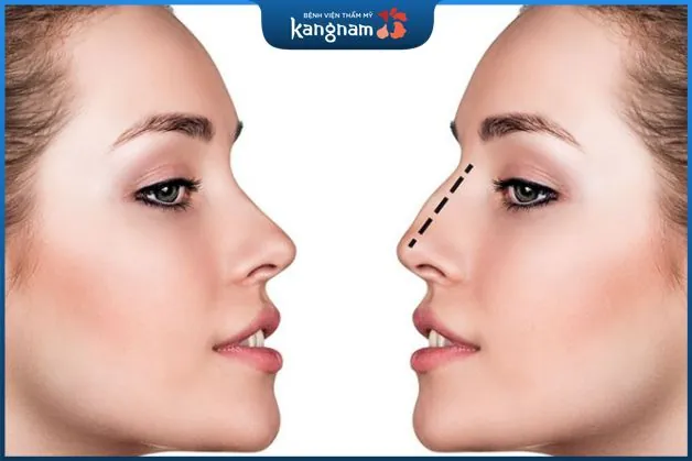 Điều trị bằng phương pháp phẫu thuật