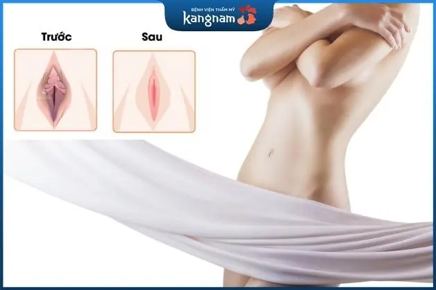 Cần kiểm tra sức khỏe trước khi làm gọn vùng kín