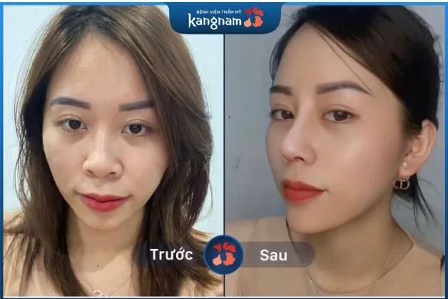 Sống mũi cao, thẳng tự nhiên