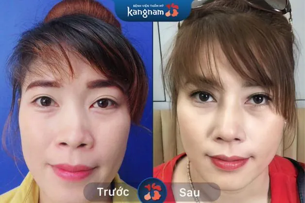 Cải thiện tình trạng sống mũi lệch vẹo hiệu quả