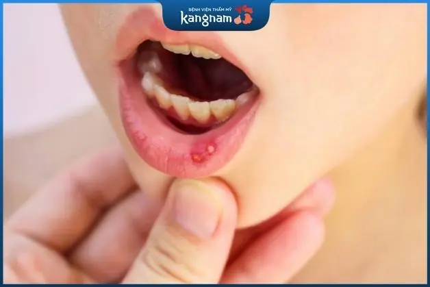 Bị nhiệt gây nên nhiều cảm giác khó chịu