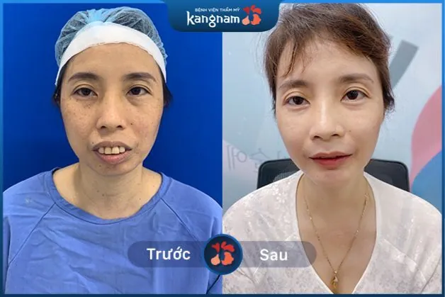 Răng hàm trên bị chìa ra ngoài kéo theo cười hở lợi