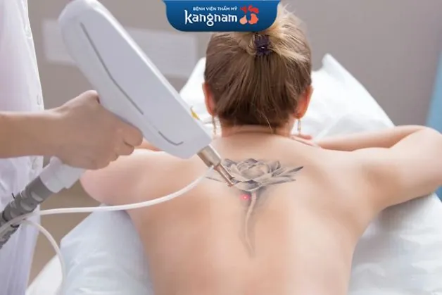 Tẩy xăm bằng laser cải thiện theo từng buổi